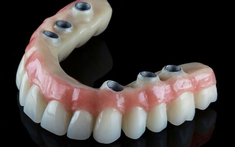 All-on-4 dentures