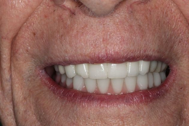 Teeth in a Day: Case 24 — after