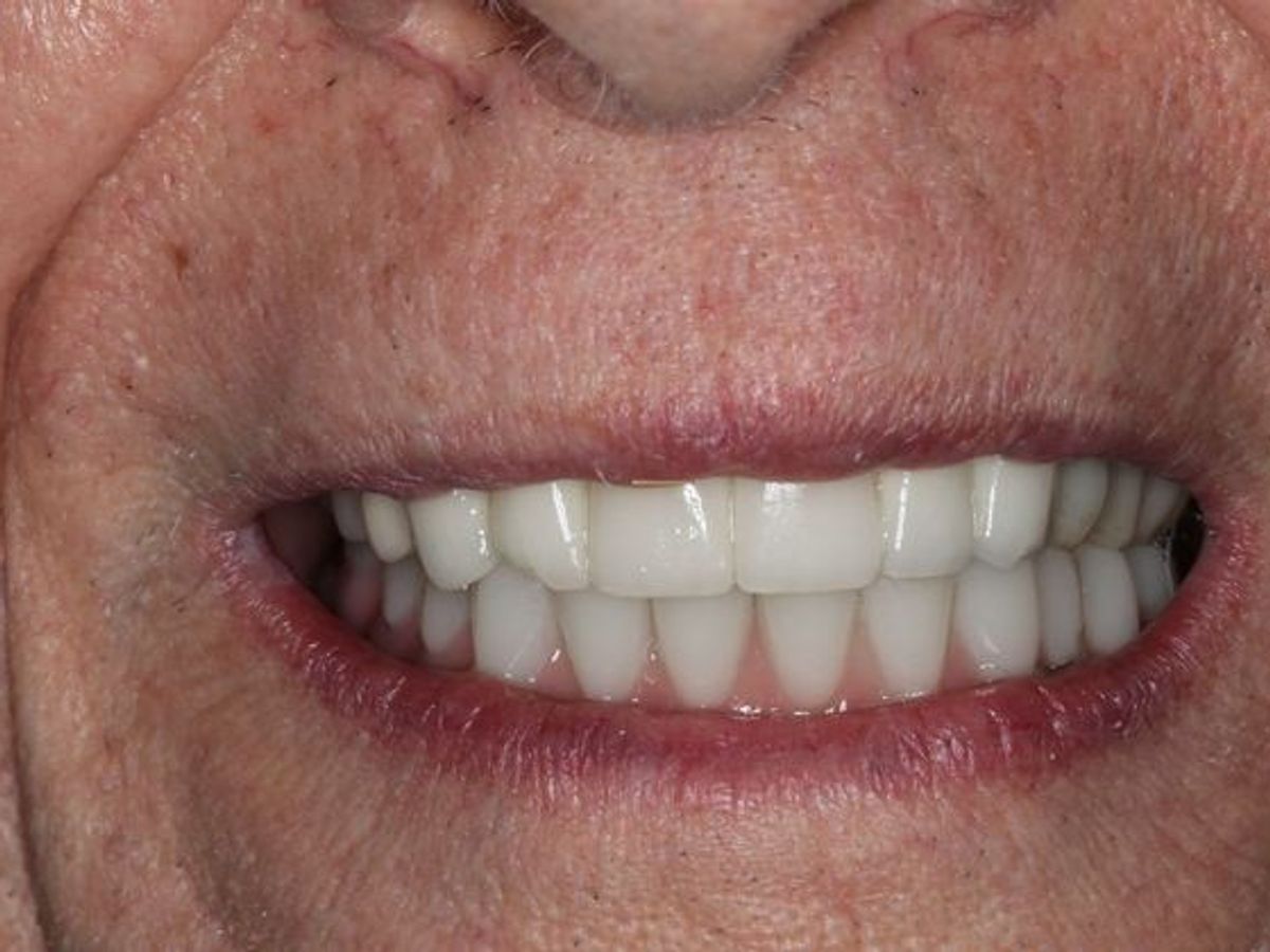 Teeth in a Day: Case 24 — after