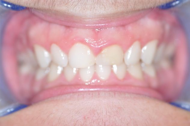 Gum Lift: Case 4/609 — before