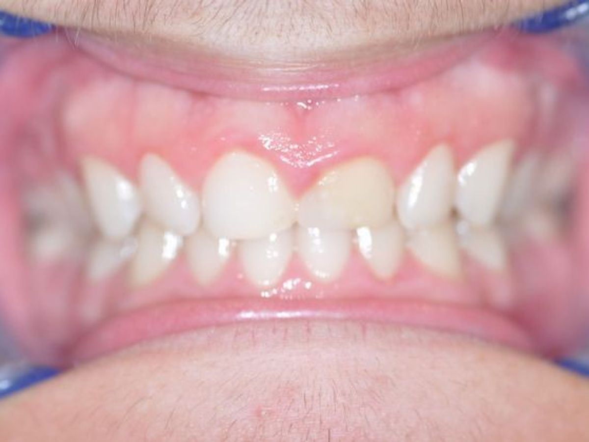 Gum Lift: Case 4/609 — before