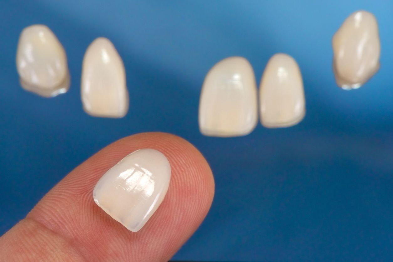 Foods and Drinks to Avoid with Veneers
