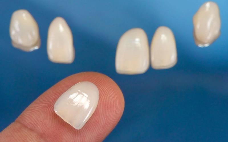 Foods and Drinks to Avoid with Veneers