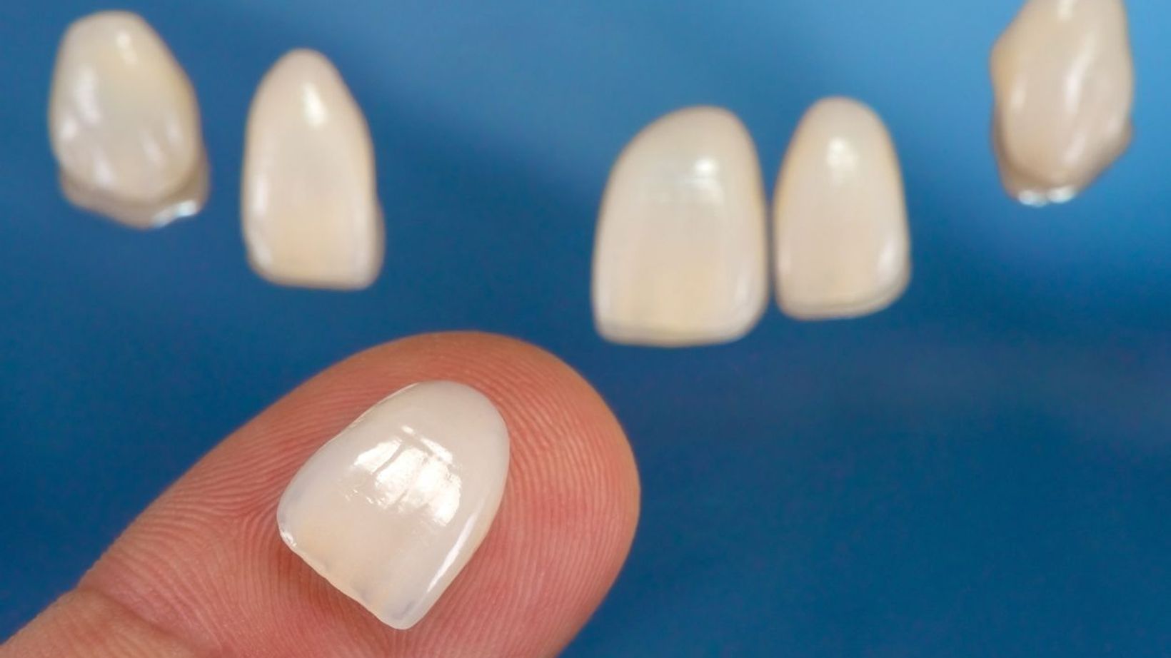 Foods and Drinks to Avoid with Veneers