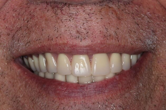 Dentures: Case 14 — Upper Overdenture after