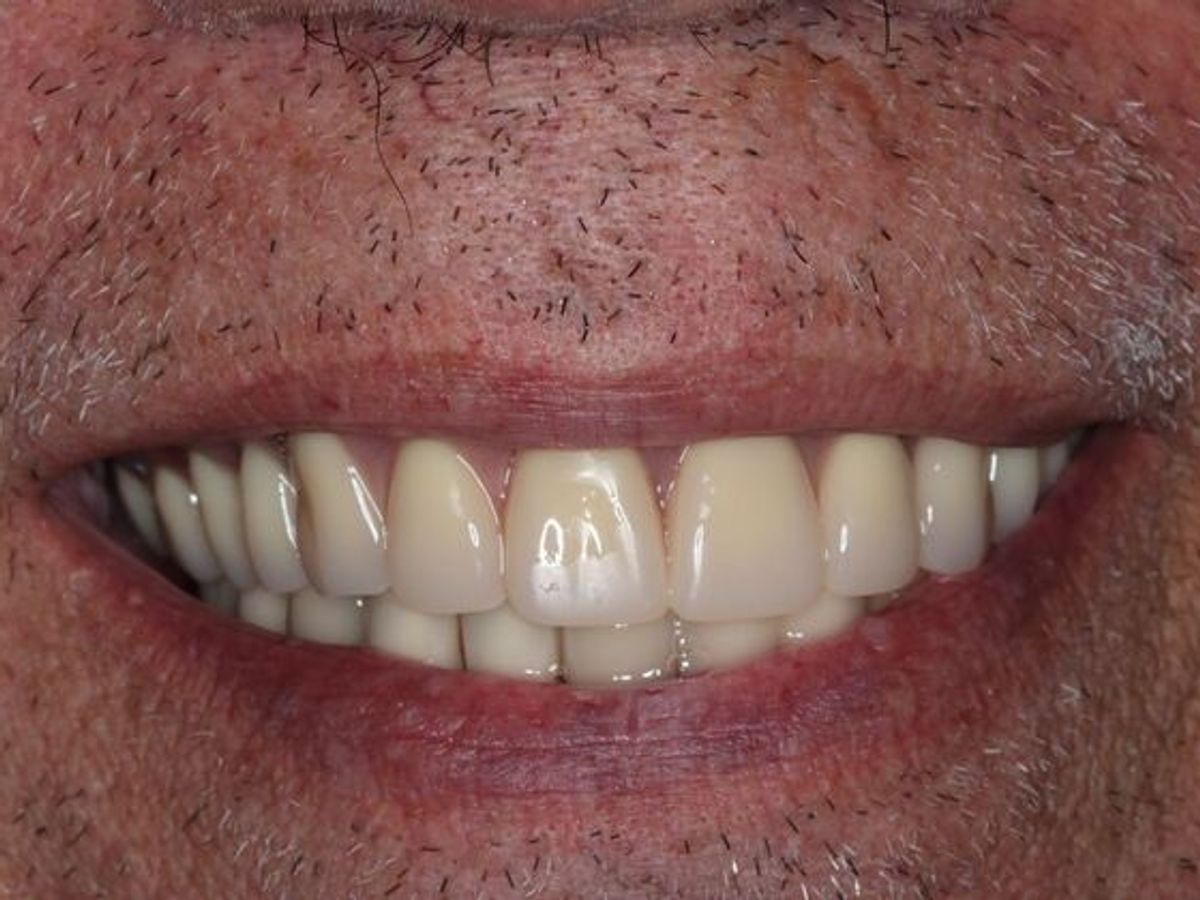 Dentures: Case 14 — Upper Overdenture after