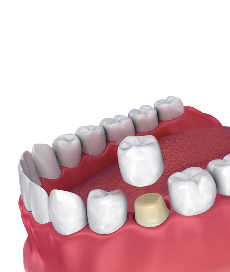 Dental Crowns After Root Canal Therapy