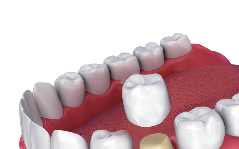 Dental Crowns After Root Canal Therapy