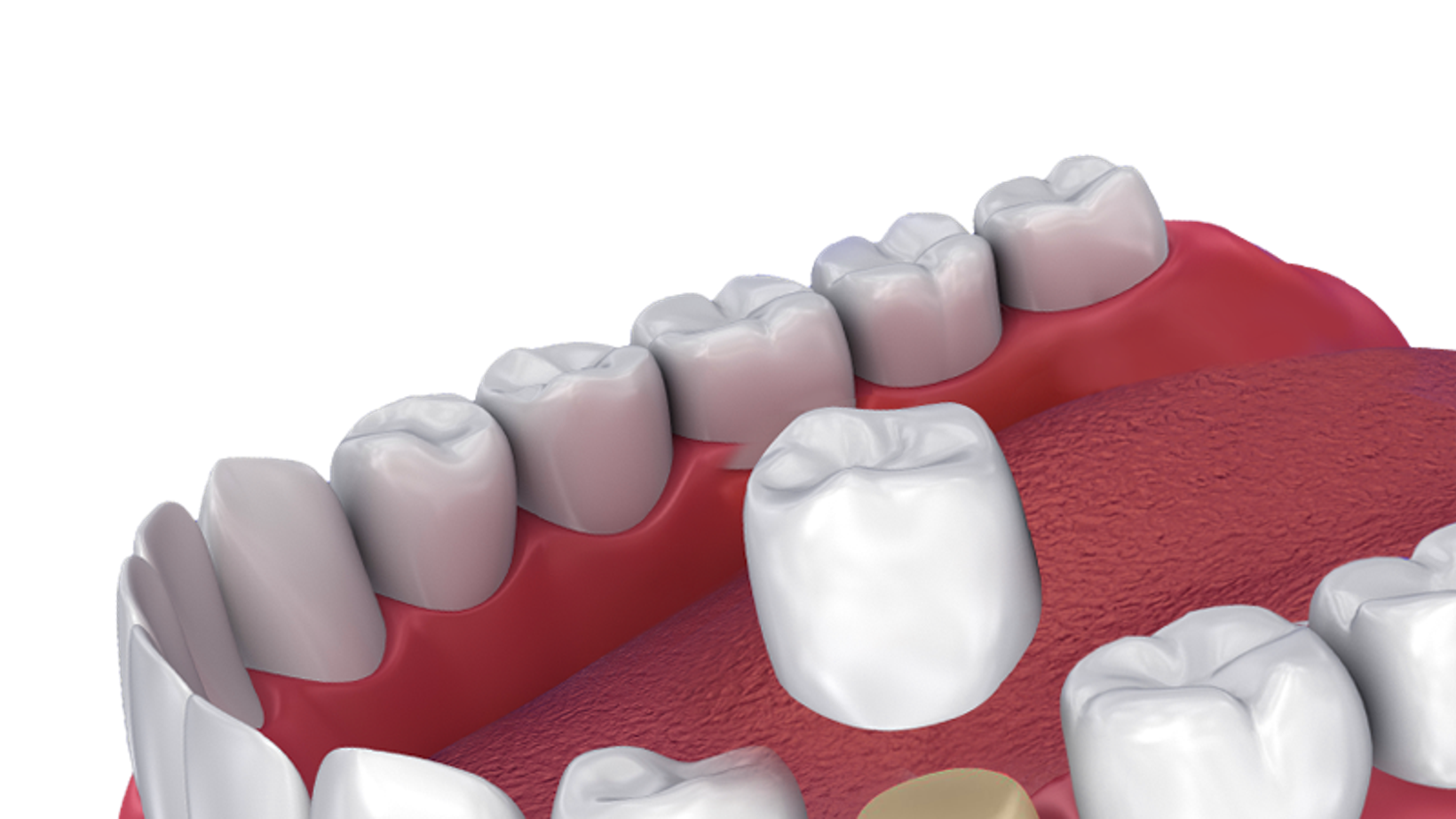 Dental Crowns After Root Canal Therapy