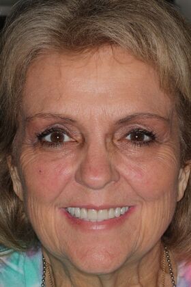 Full Mouth Reconstruction: Case 10 — after