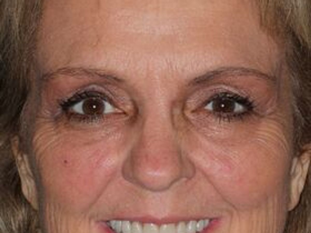 Full Mouth Reconstruction: Case 10 — after