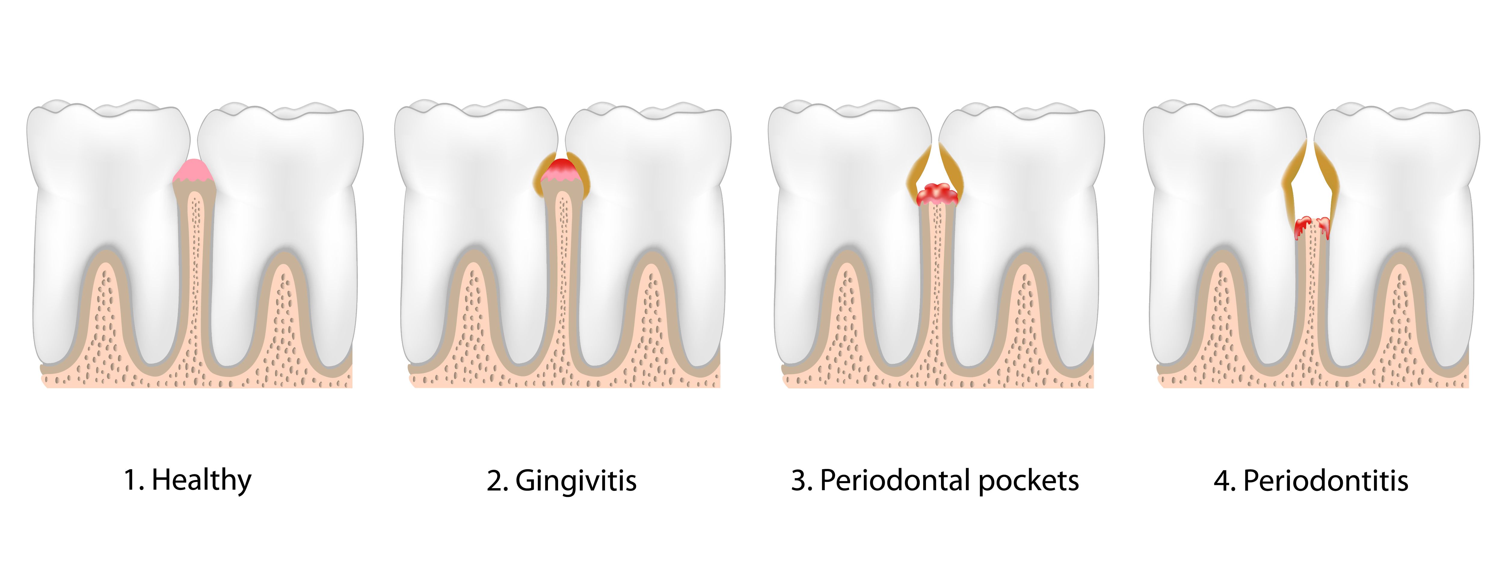How Gum Disease Causes Tooth Loss
