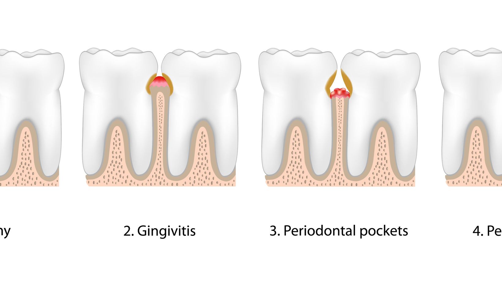 How Gum Disease Causes Tooth Loss