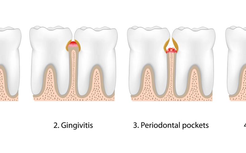 How Gum Disease Causes Tooth Loss