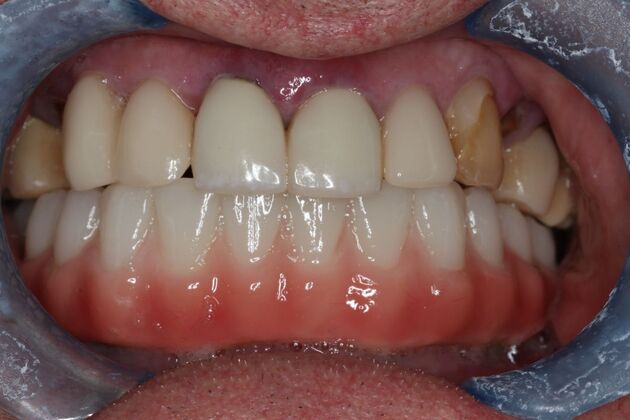 Teeth in a Day: Case 29 — Before Lower All on 4 / After LowerAll on 4 after