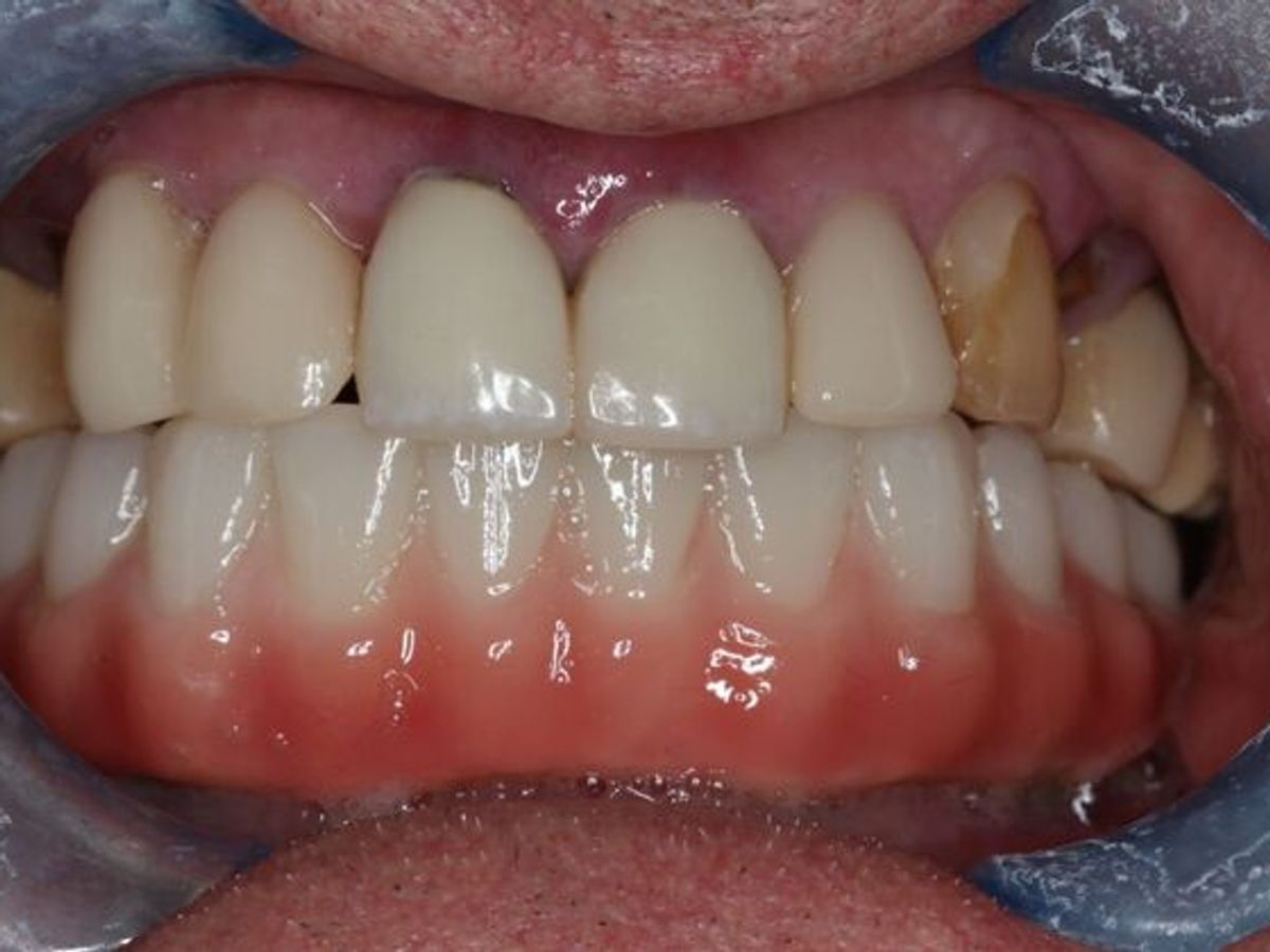 Teeth in a Day: Case 29 — Before Lower All on 4 / After LowerAll on 4 after