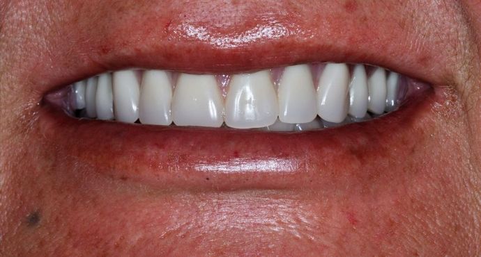 Teeth in a Day: Case 18 — after