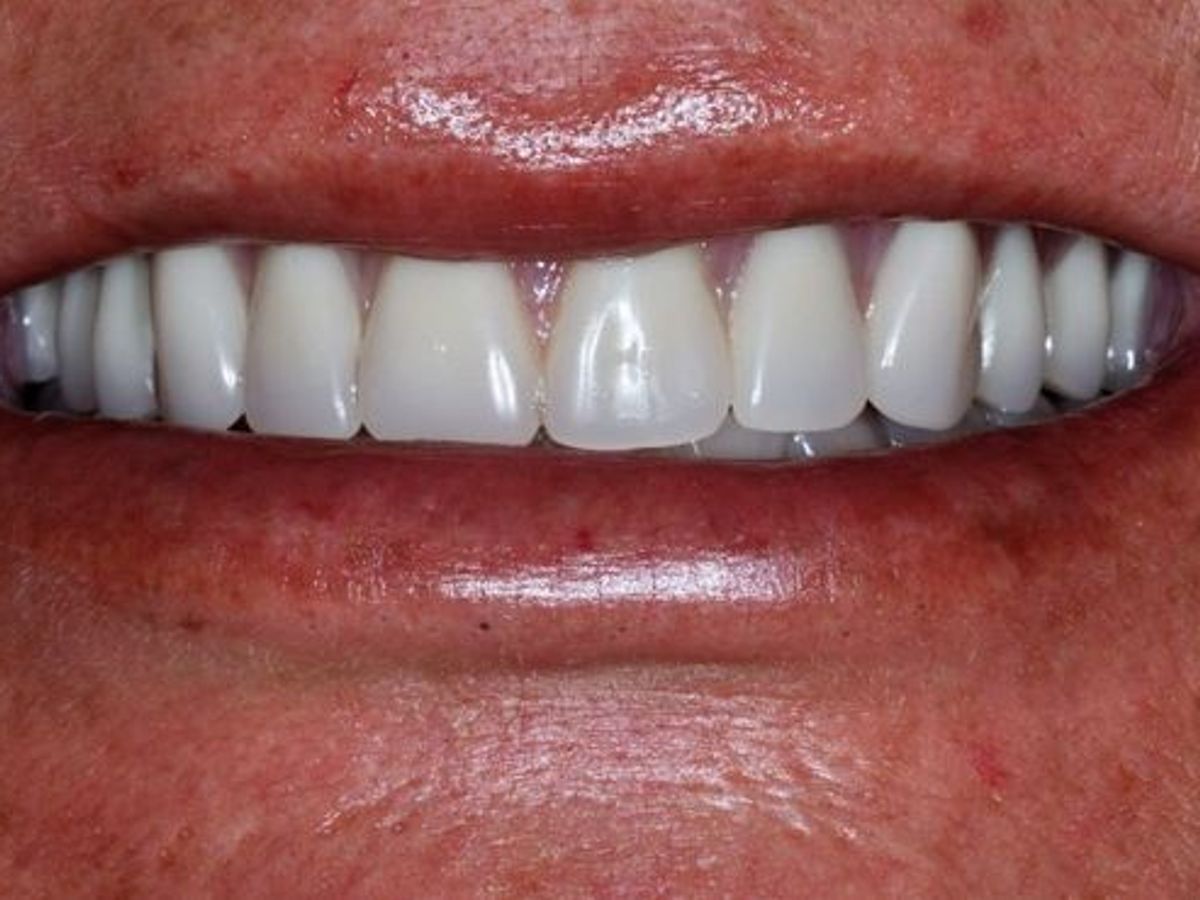 Teeth in a Day: Case 18 — after