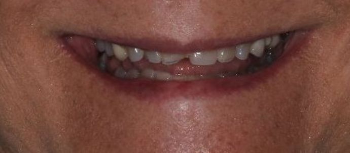 Dental Crowns: Case 26 — before