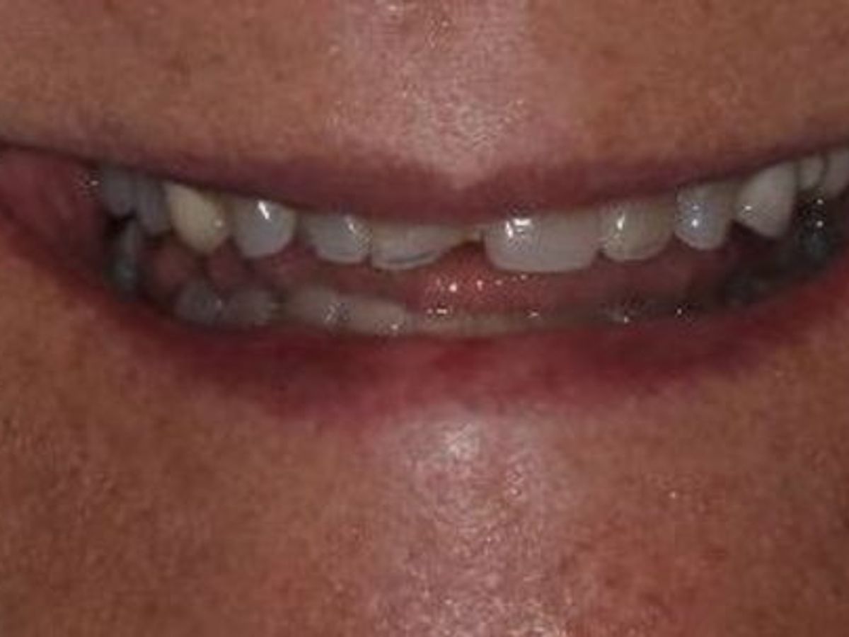 Dental Crowns: Case 26 — before