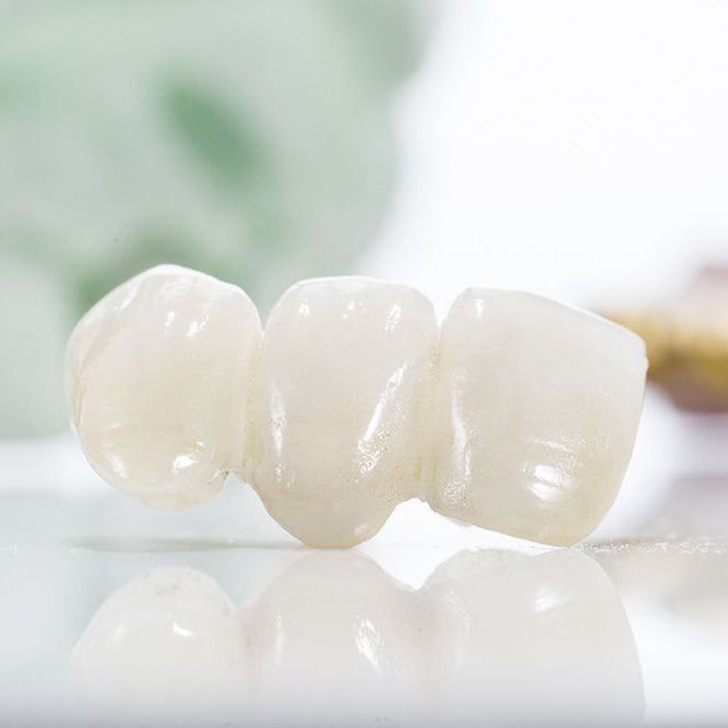 History of Dental Bridges