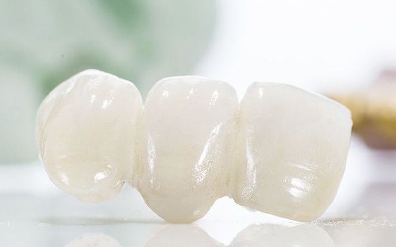History of Dental Bridges