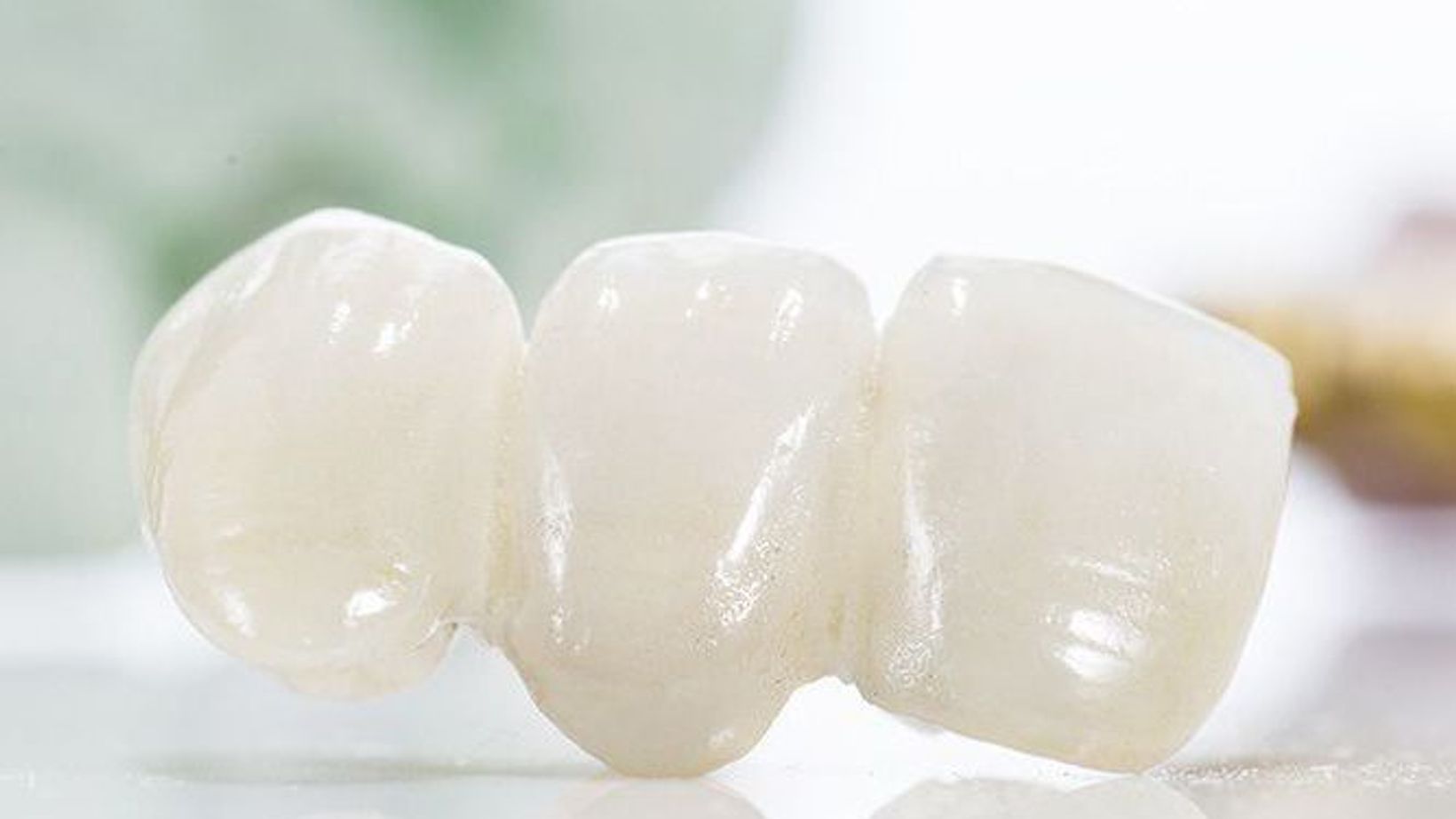 History of Dental Bridges
