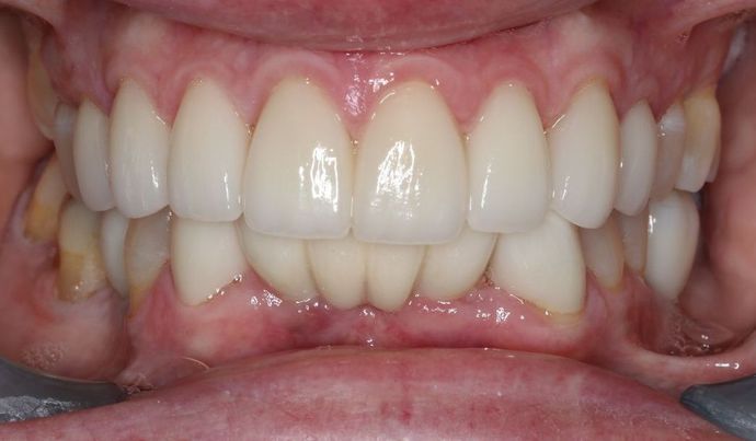 Dental Implants: Case 5 — after