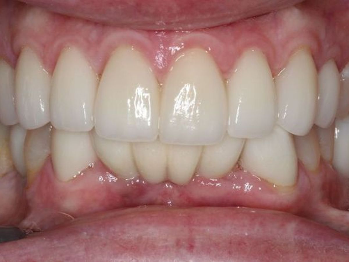 Dental Implants: Case 5 — after