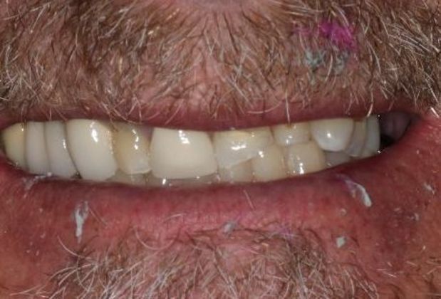 Dental Crowns: Case 29 — before