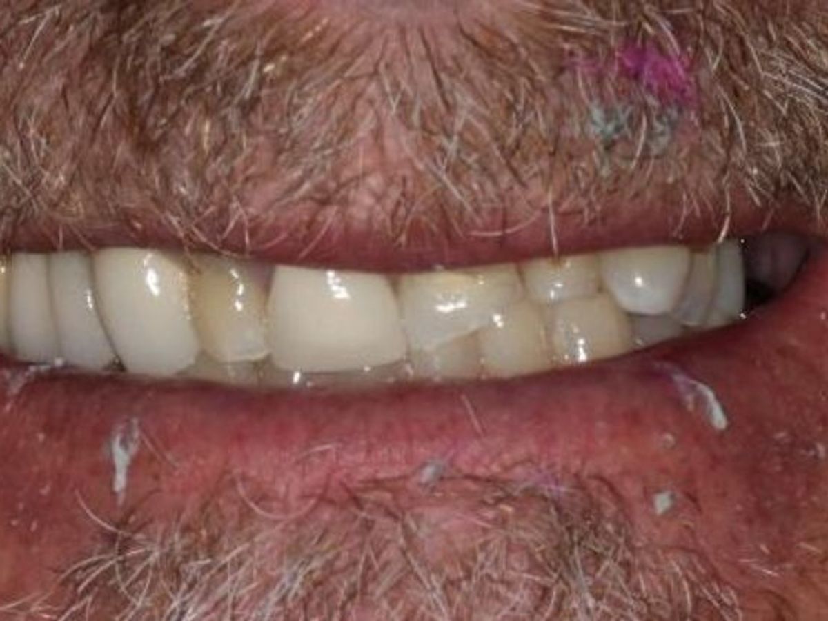 Dental Crowns: Case 29 — before