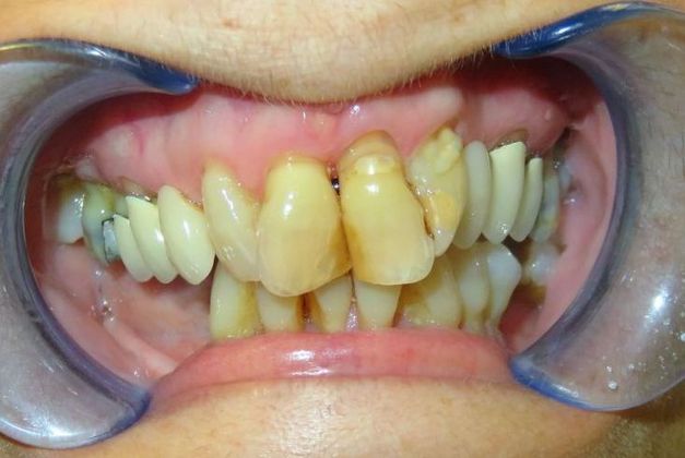 Teeth in a Day: Case 8 — before
