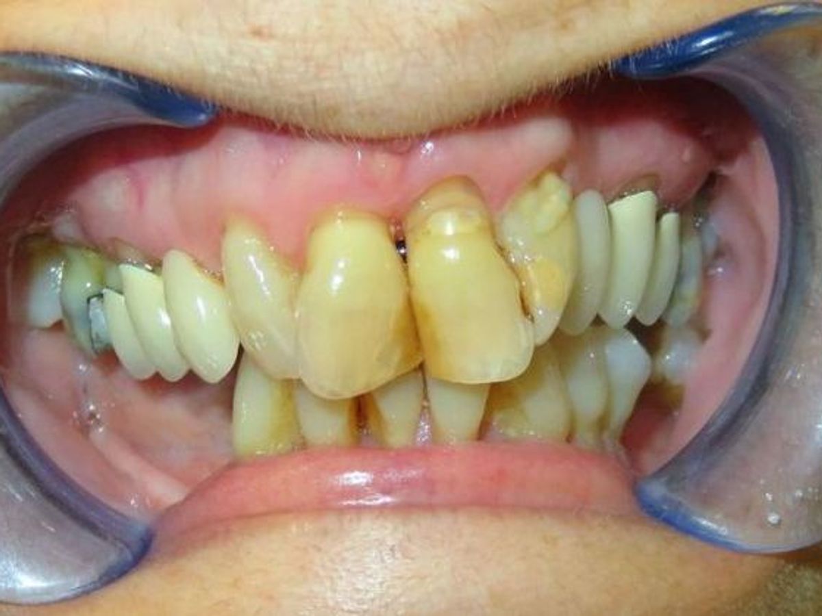 Teeth in a Day: Case 8 — before