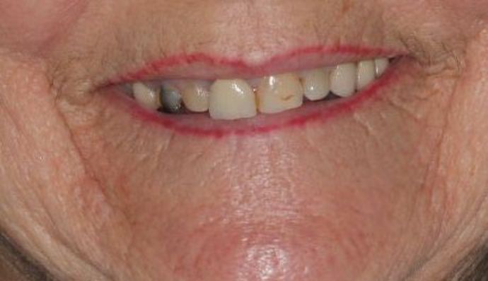 Dentures: Case 6 — before