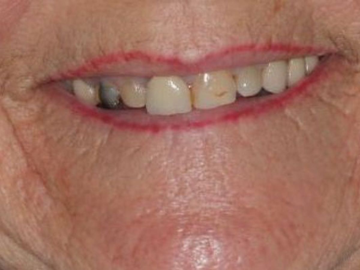 Dentures: Case 6 — before