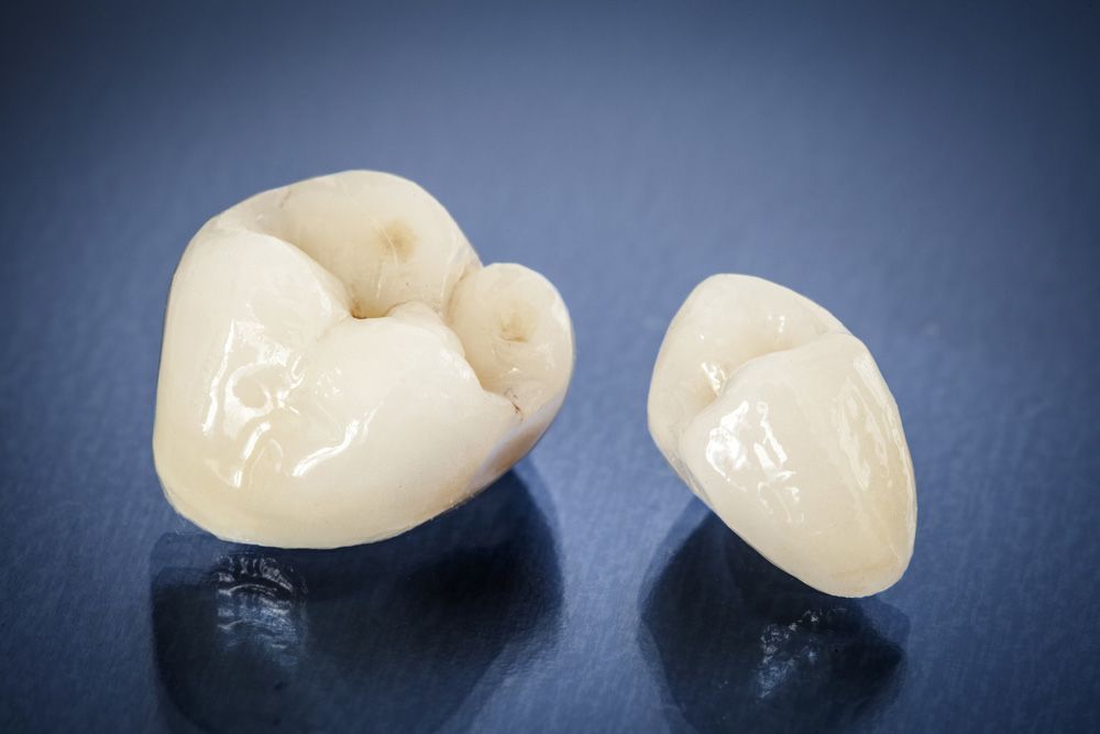 Porcelain Crown vs. Veneers