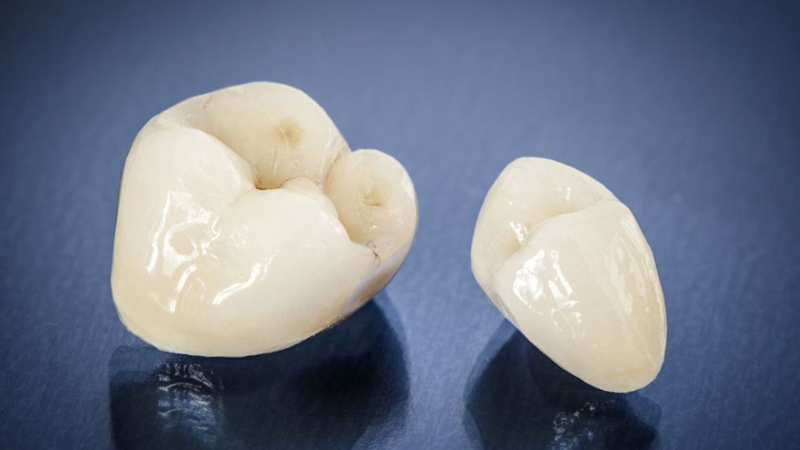 Porcelain Crown vs. Veneers