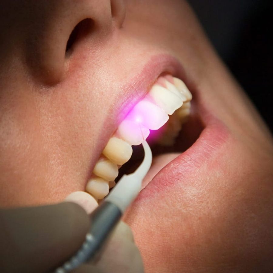 Cosmetic Gum Contouring