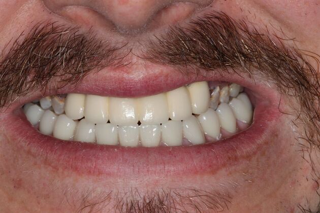 Dental Implants: Case 13 — Lower Locator Denture after