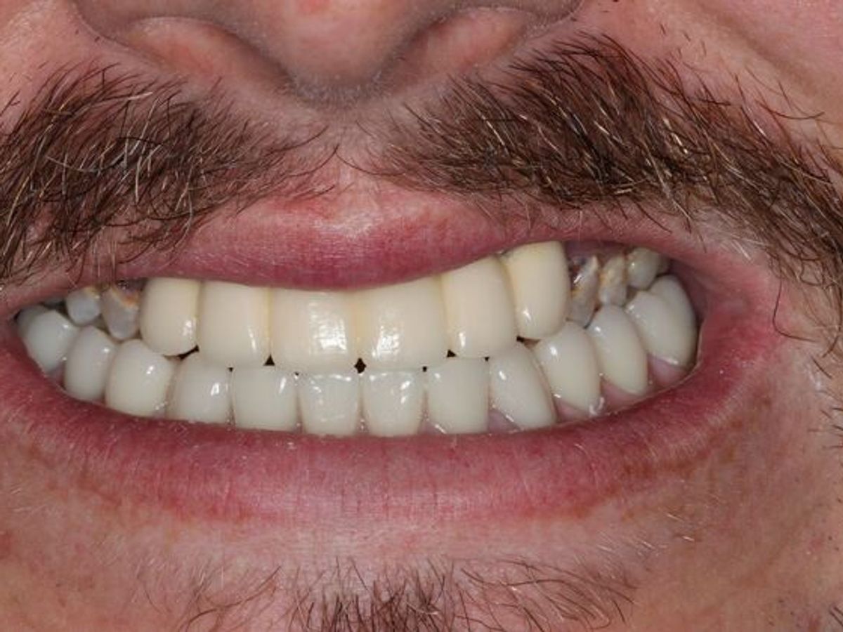 Dental Implants: Case 13 — Lower Locator Denture after
