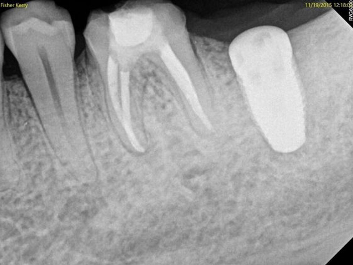 Dental Implants: Case 9 — before