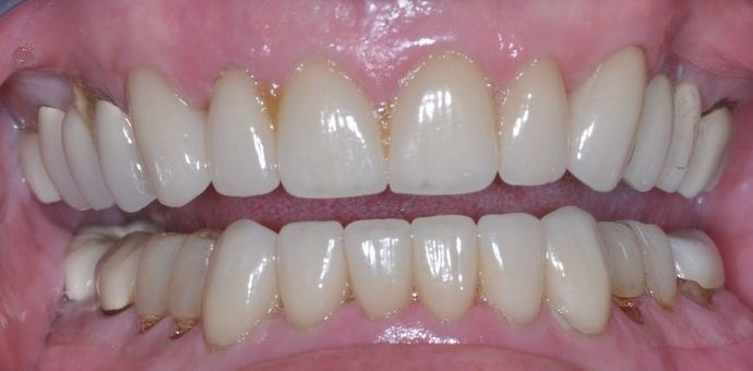 Dental Crowns: Case 6 — after