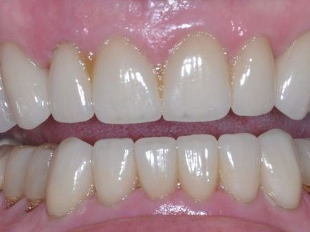 Dental Crowns: Case 6 — after