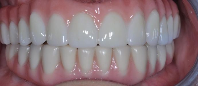 Teeth in a Day: Case 16 — Upper and Lower Arch after