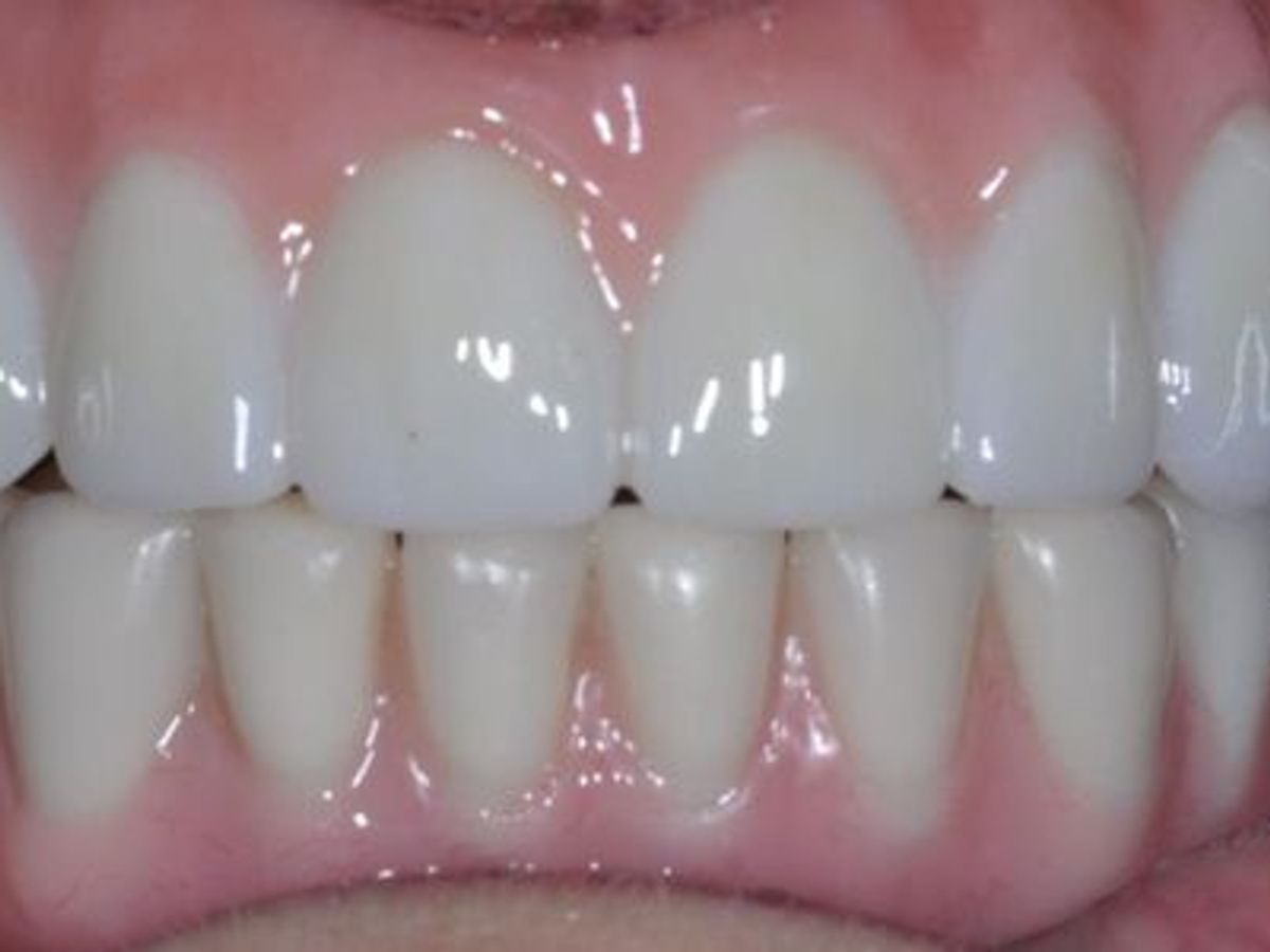 Teeth in a Day: Case 16 — Upper and Lower Arch after