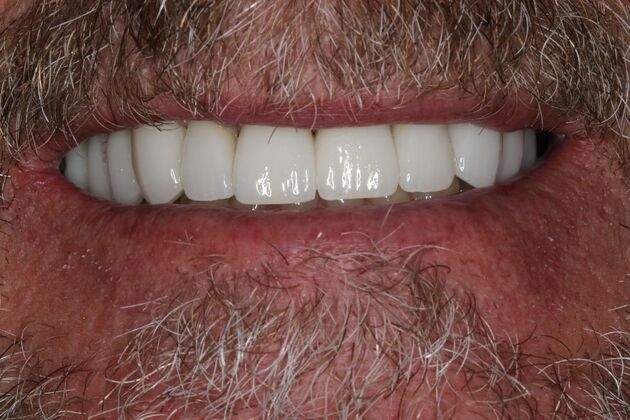 Full Mouth Reconstruction: Case 9 — after