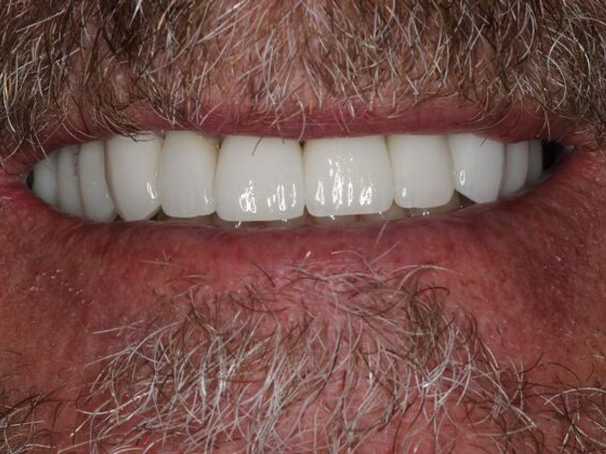 Full Mouth Reconstruction: Case 9 — after