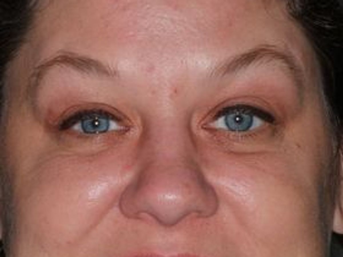 Dental Implants: Case 1 — before