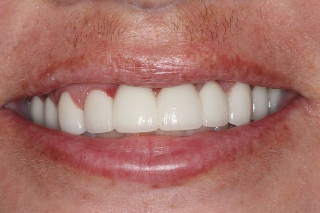 Dental Crowns: Case 28 — after