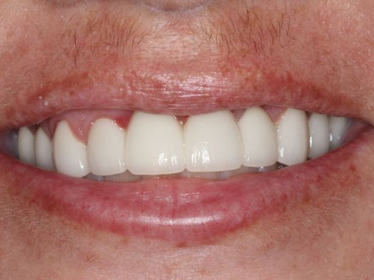 Dental Crowns: Case 28 — after